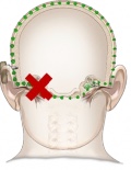 Bone anchored hearing