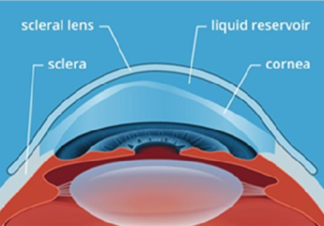 Scleral contact lens, 2