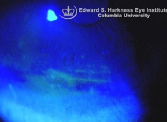 Corneal Staining