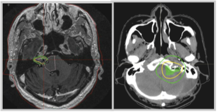 Fractionated Radiotherapy